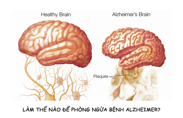 Làm thế nào để phòng ngừa bệnh Alzheimer